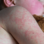 Brote de sarampión en La Palma: Casos confirmados ascienden a 21 en las Islas Canarias