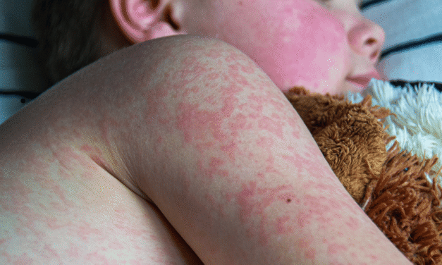 Brote de sarampión en La Palma: Casos confirmados ascienden a 21 en las Islas Canarias